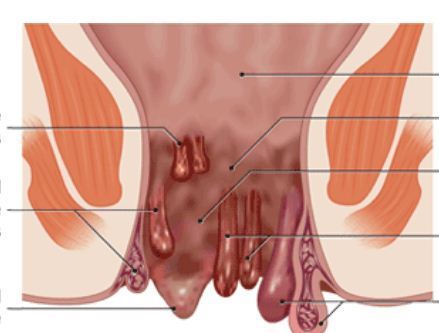 Piles specialist surgeon in Kanpur