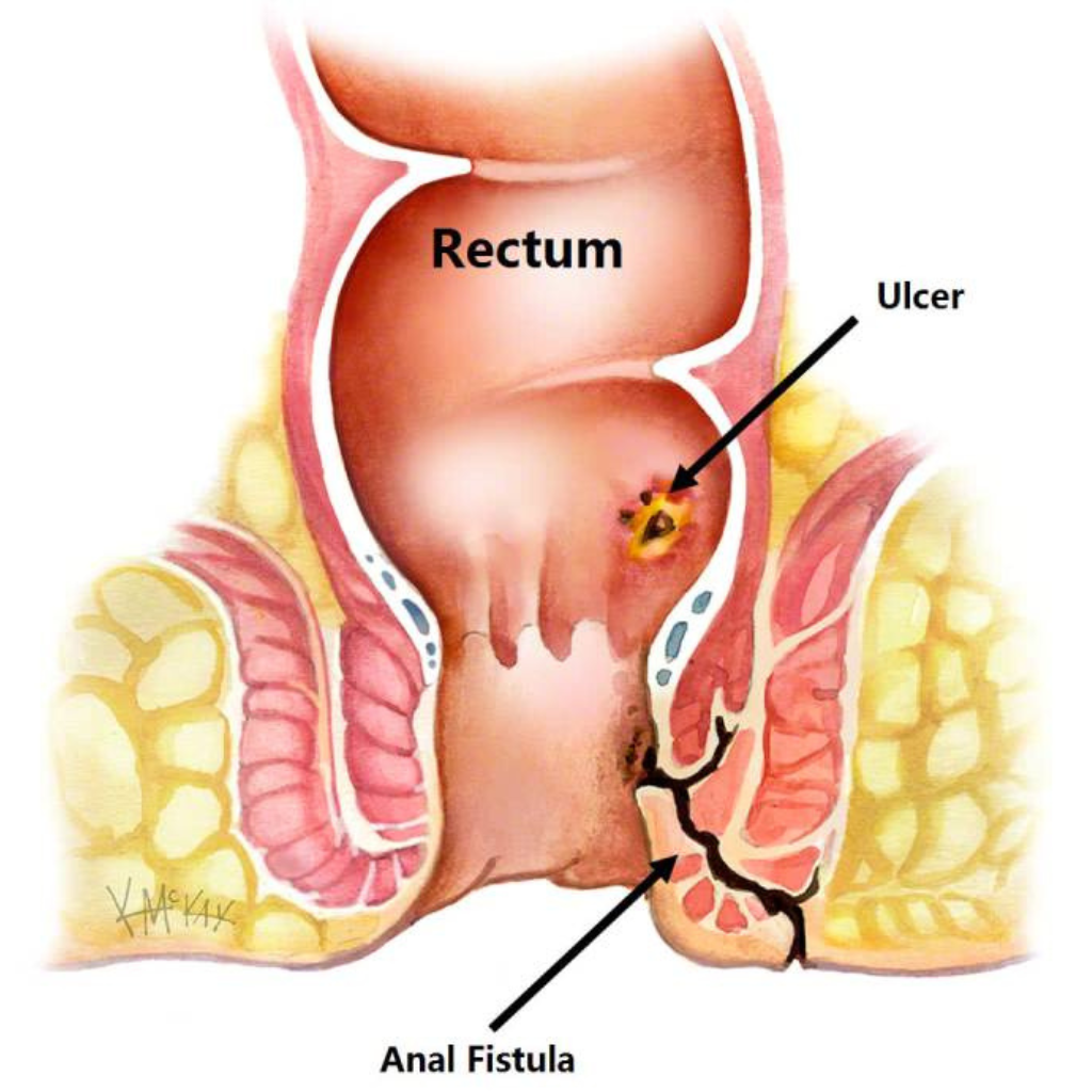 Best Fistula Surgeon Doctors in Kanpur