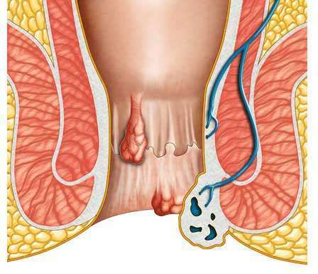 Fistula laser Treatment in Kanpur