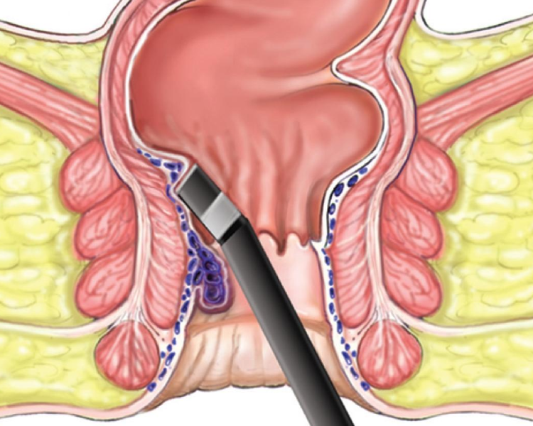 Piles laser treatment in Kanpur