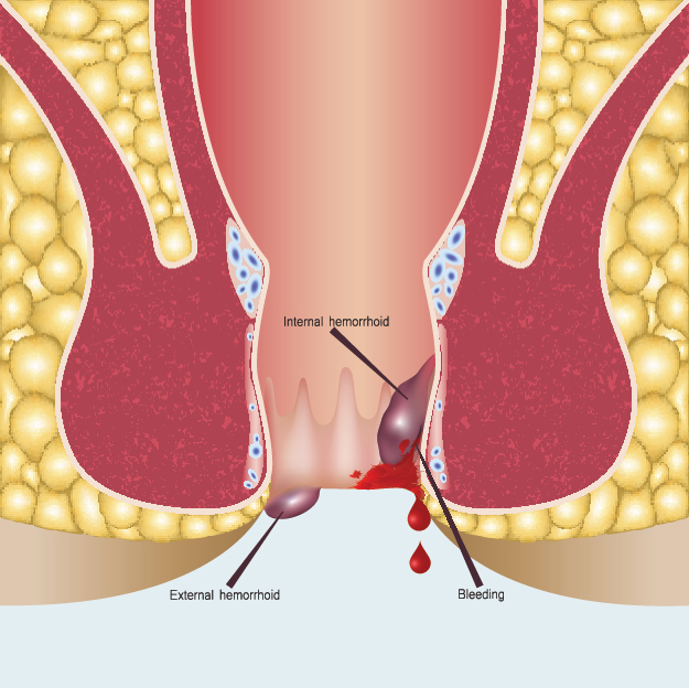 Piles specialist doctor in Kanpur
